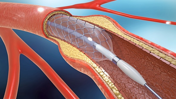 O que é um stent cardíaco